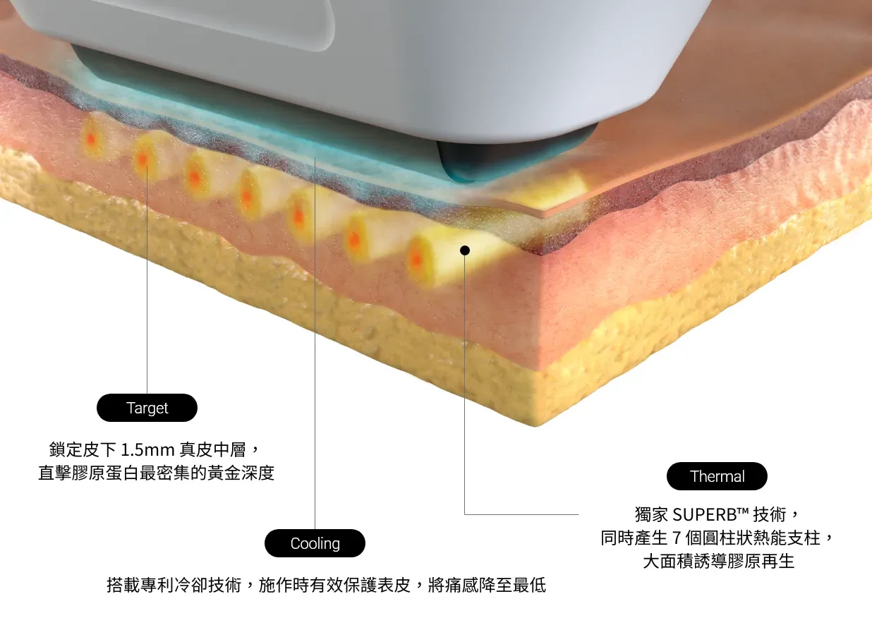 鎖定皮下 1.5mm 真皮中層,直擊膠原蛋白最密集的黃金深度